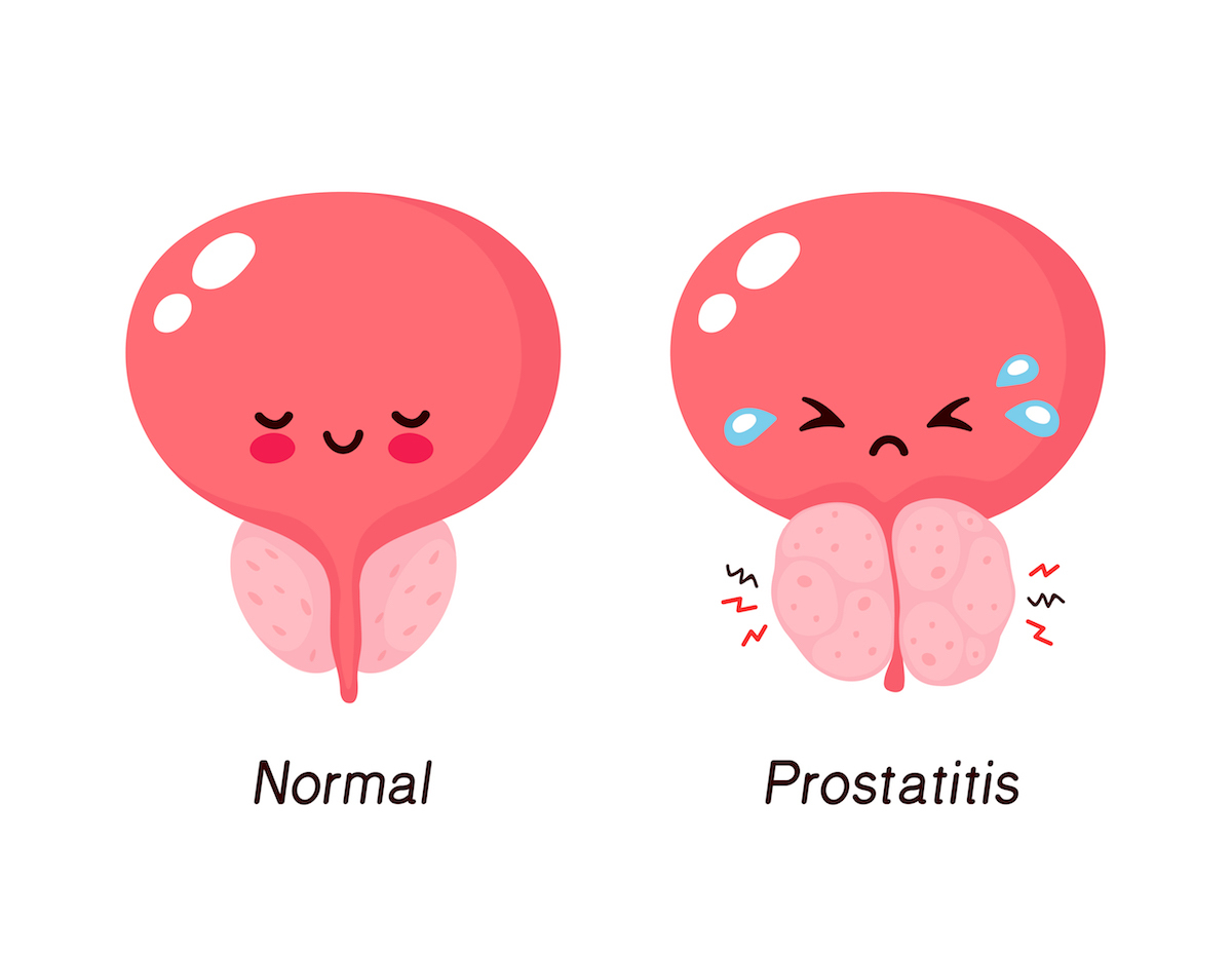 cinkite a prostatitis alatt